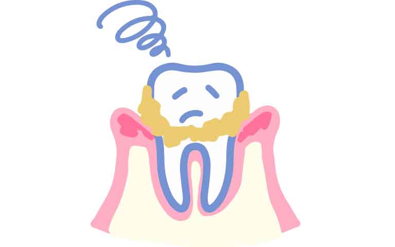 歯周病は歯を失う1番の原因です