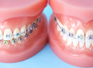 歯並びの相談は個人によって異なる