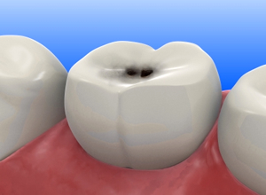 歯周病や虫歯の発生、悪化