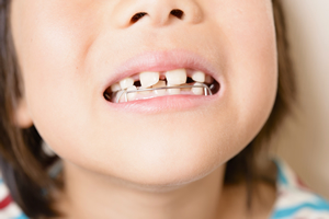 子供のうちに歯列矯正するメリット