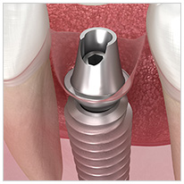 アバットメント