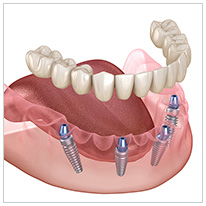 オールオンフォー