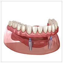 オーバーデンチャー