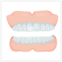 インビザライン矯正
