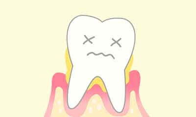 歯周病と歯槽膿漏の違いはなんですか？