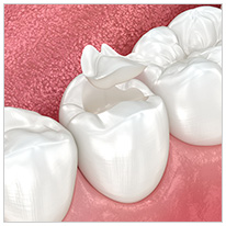 インレー(詰め物)